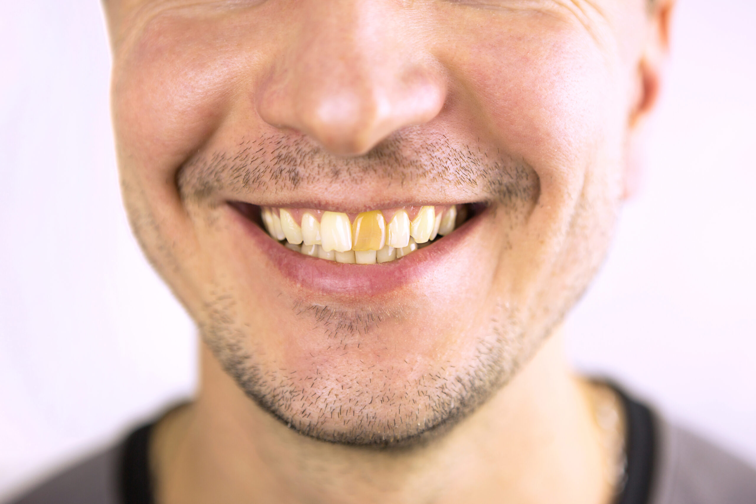 Man smiling broadly displaying teeth against white background for dental practice.